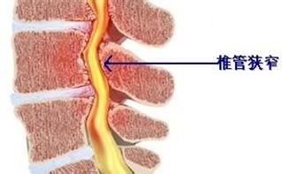 怎样预防椎管狭窄 怎样预防椎管狭窄