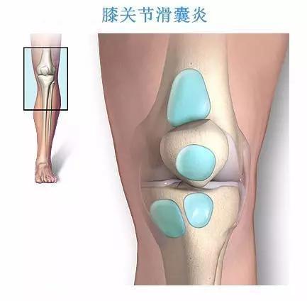 膝关节滑膜炎是怎么产生的?