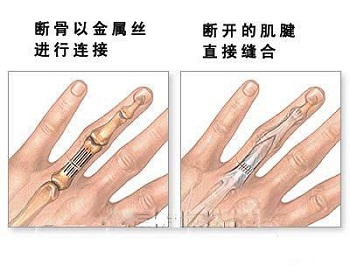 断指再植3.jpg