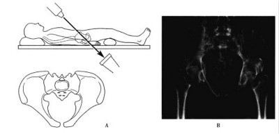骨盆骨折的X射线检测.jpg